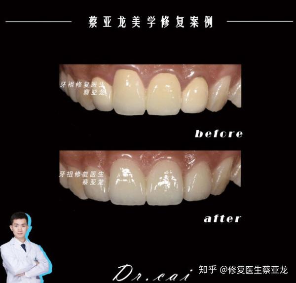 全瓷牙替换烤瓷牙