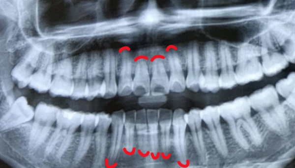 去看个牙医生总说牙根吸收了是咋回事