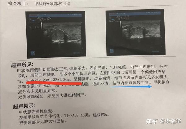甲状腺结节b超中,血流信号如何解读?血流信号丰富好还是不好?
