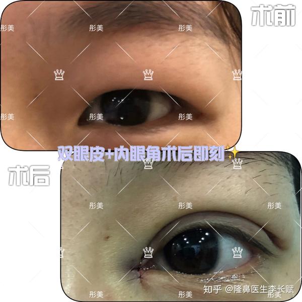 鱼泡眼
