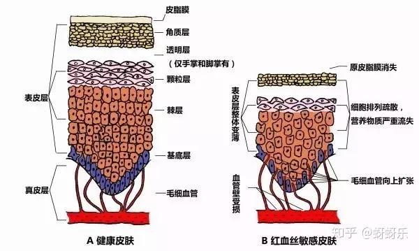 总结来说就是: 皮层过薄,皮下毛细血管增生,形成了无法恢复的扩张毛细