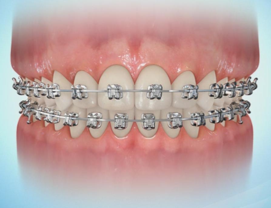 金属托槽矫正会伤害牙齿吗?