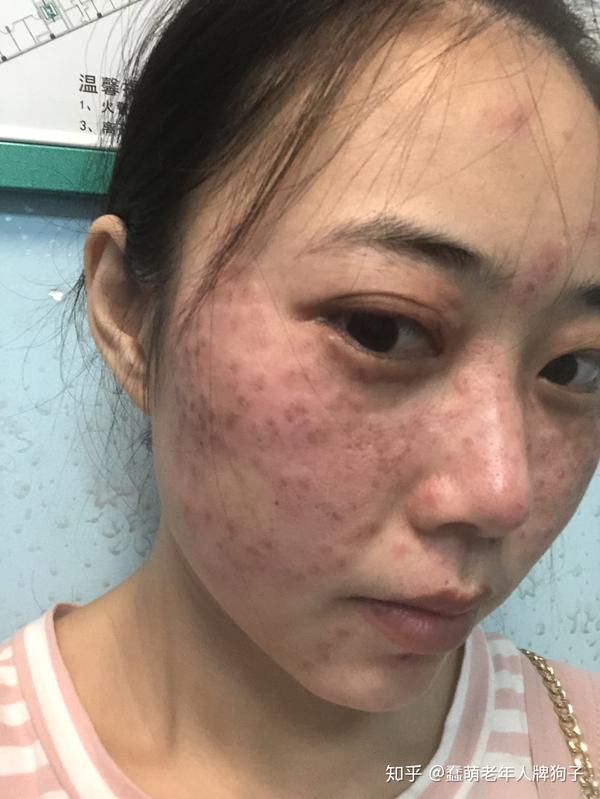 怎么去雀斑激光祛斑怎么样