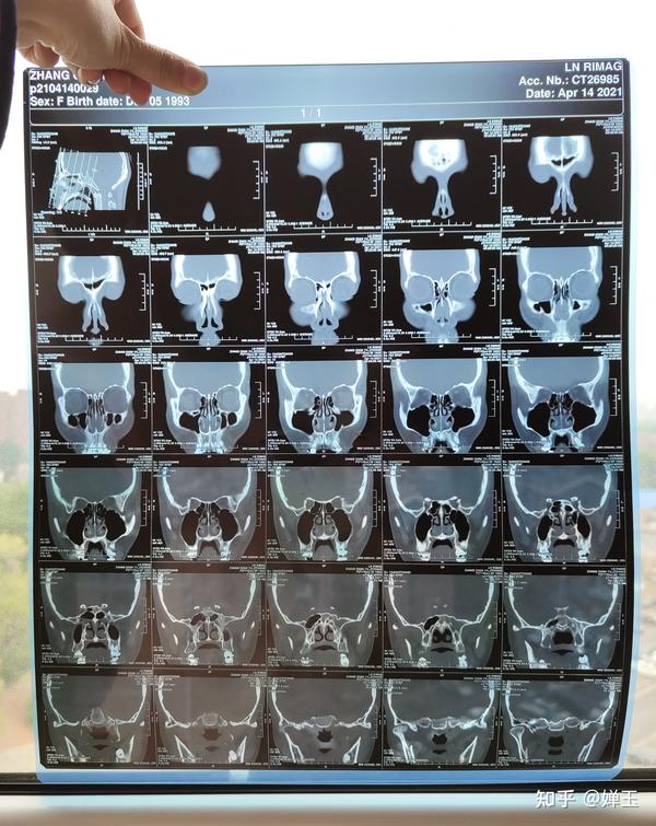给大家放一给大家放一下我术前的ct片