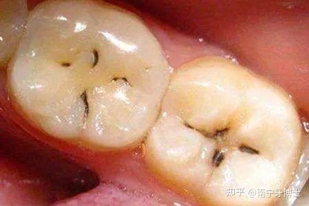 发黑的牙齿都是蛀牙吗?