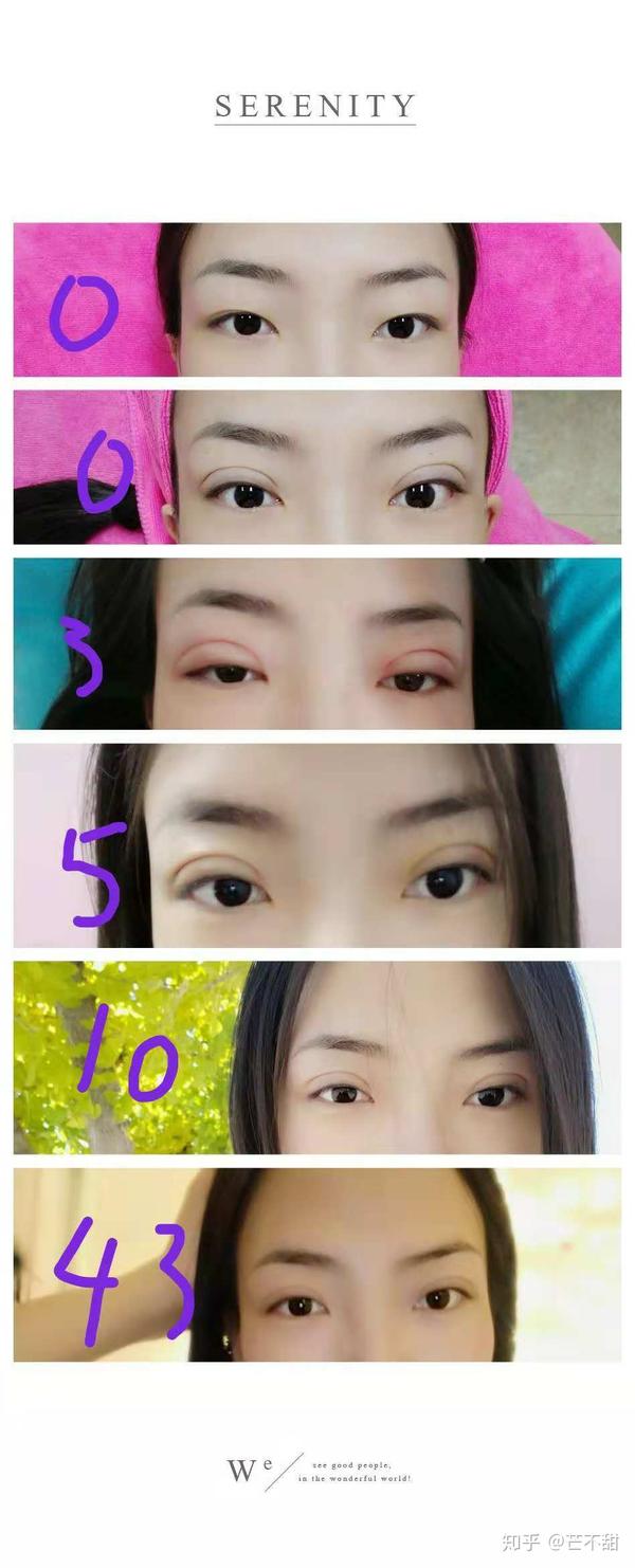 割双眼皮对外貌的改变大吗?