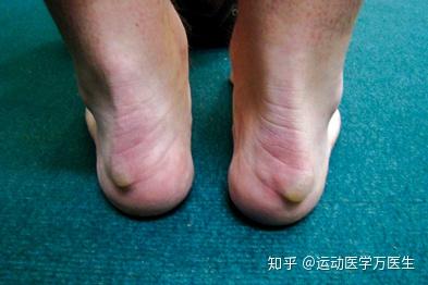 在门诊中,偶尔会碰到这样的病人,说自己脚后跟肿起来并且伴疼痛,走路