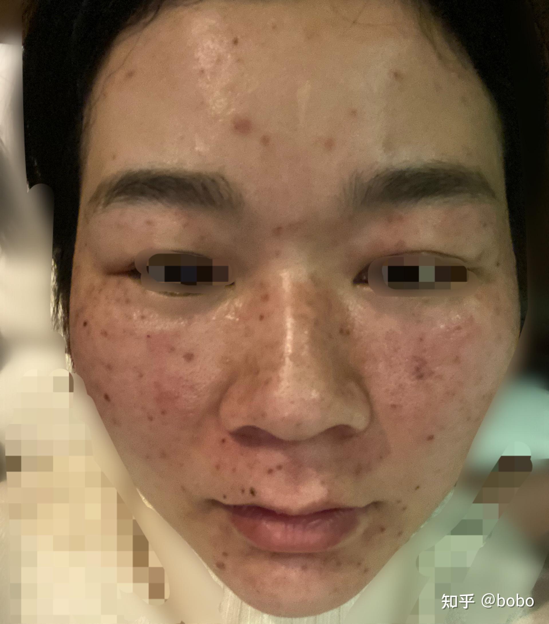 记录全过程湘雅二的激光祛斑