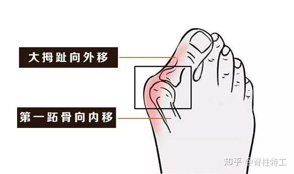 关于『拇外翻』的超全解读!