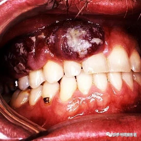 口腔表征为在口腔上腭,牙龈及舌部发生单个或多个红,蓝或紫色肉瘤,病