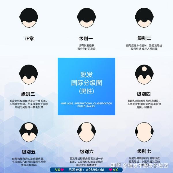 国际上把脱发分为7个等级