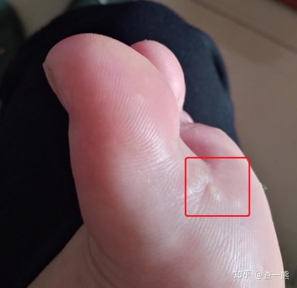 脚上长了个硬的包,挖掉了一个后来长了一堆.