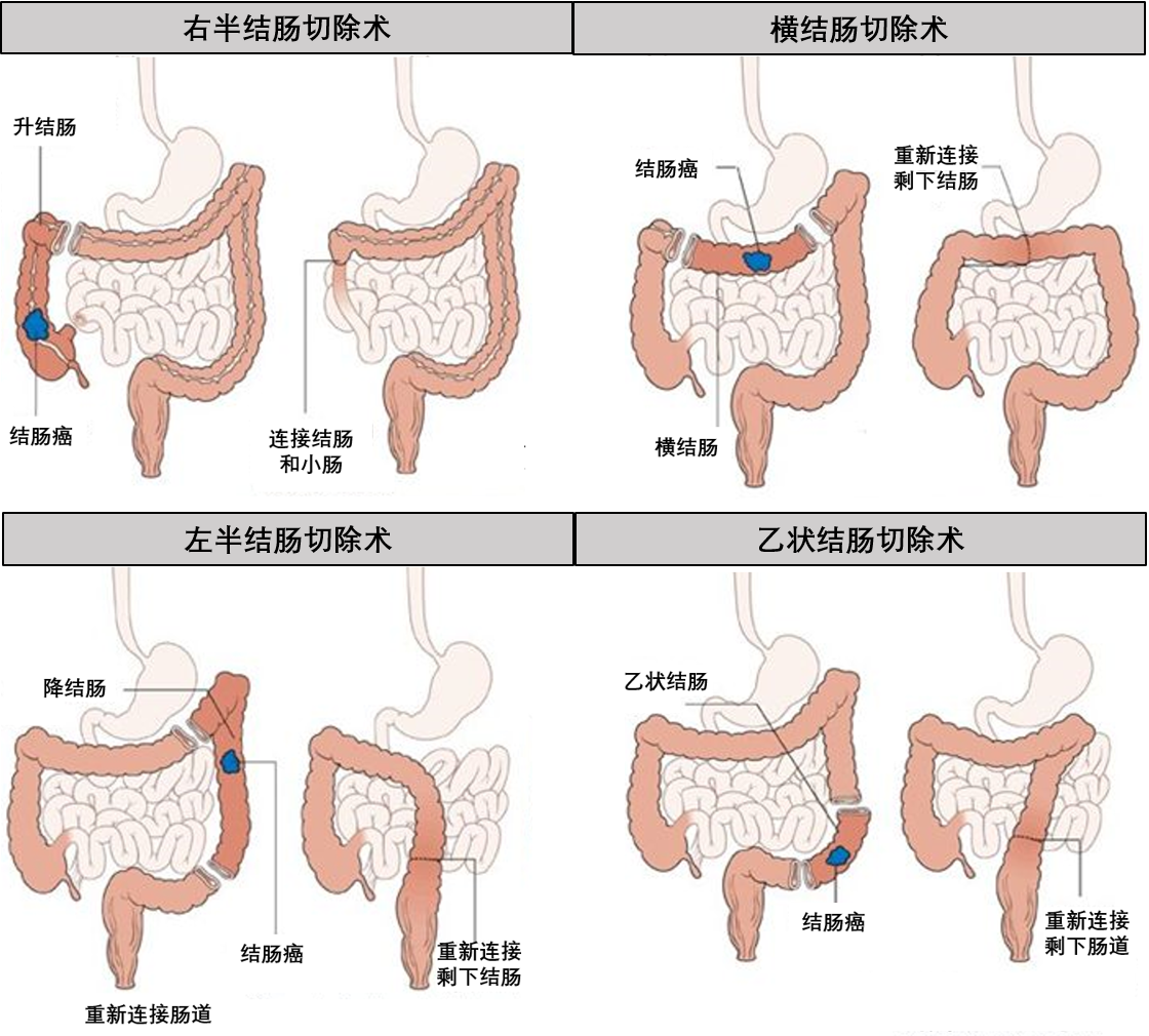 结肠癌术后:并发症管理,肠道功能改变和应对,随访等