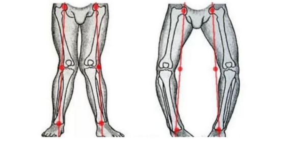 另外一种情况就是皮相上的 很多人的x,o型腿,其实并不是骨骼的问题