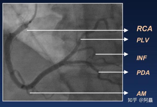 coronary artery 锐缘支(am,acute marginal branch 后降支(pda