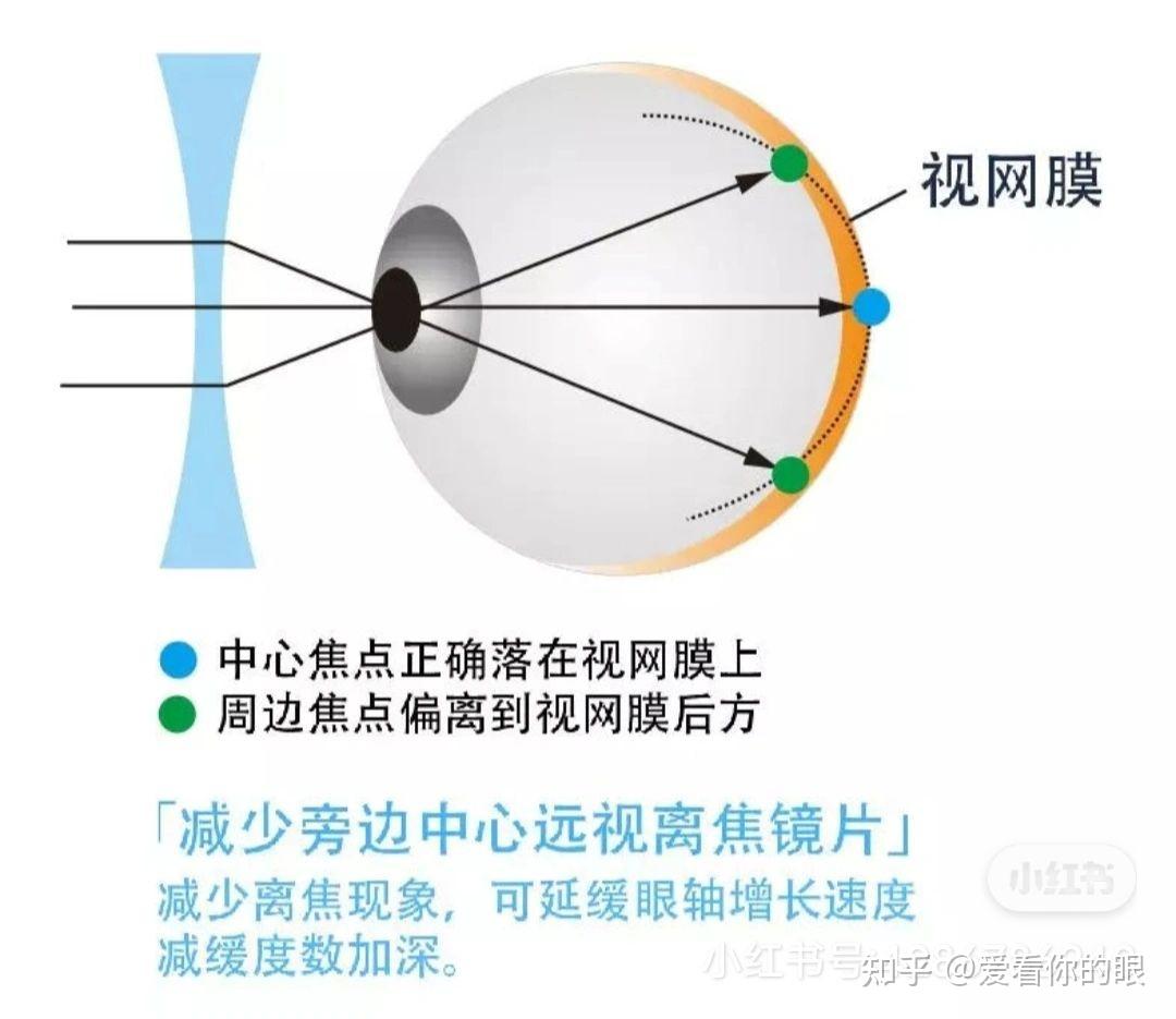 离焦眼镜新乐学星趣控等正确的佩戴方法推演