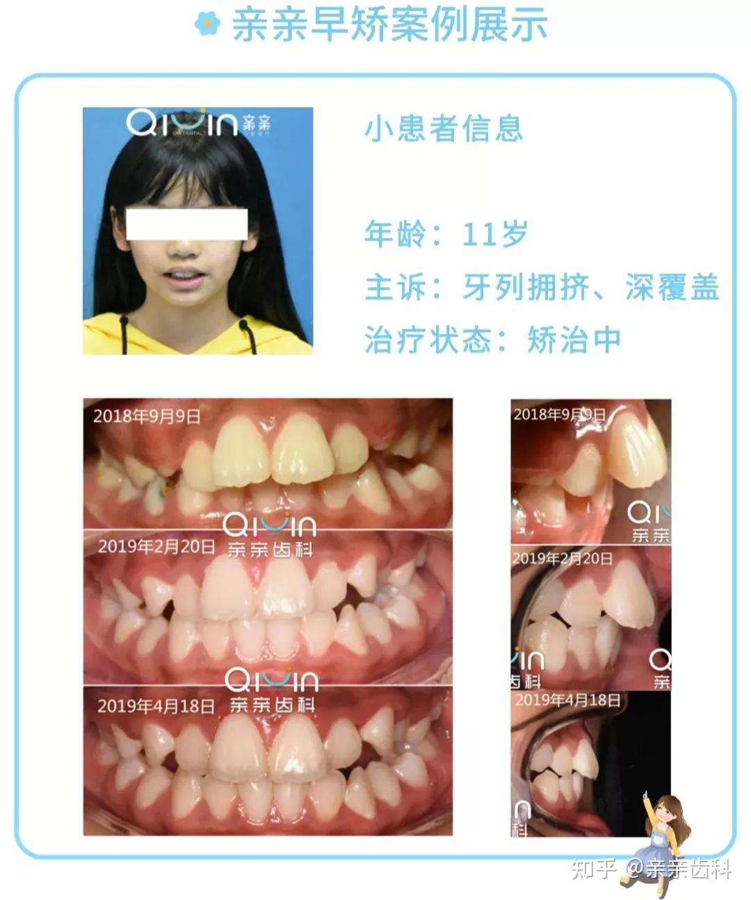 而那时孩子可能就要忍受拔牙之苦,而且矫正难度也会加大,费用也相对较