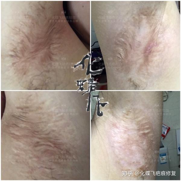 腋下疤痕大部分都是黏连居多.
