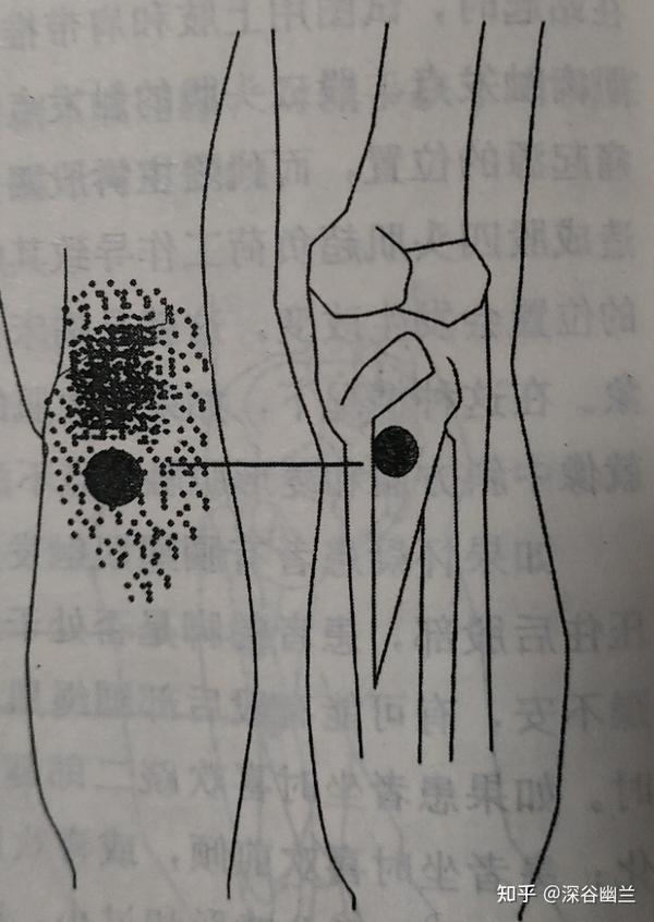腘肌触发点的牵涉痛基本集中在腘窝偏下的位置,并向周围弥散.