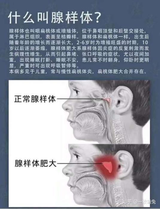 在炎症的反复刺激下,会造成增生肥大,造成鼻塞,打呼噜甚至腺样体面容