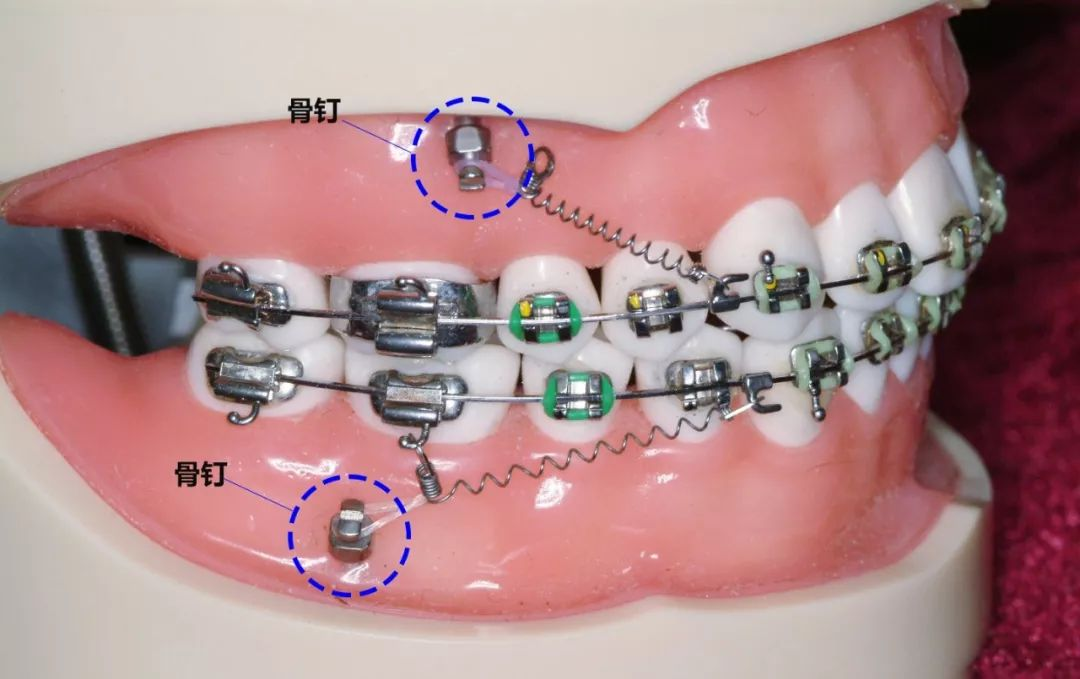 牙齿矫正中支抗钉的作用是什么?