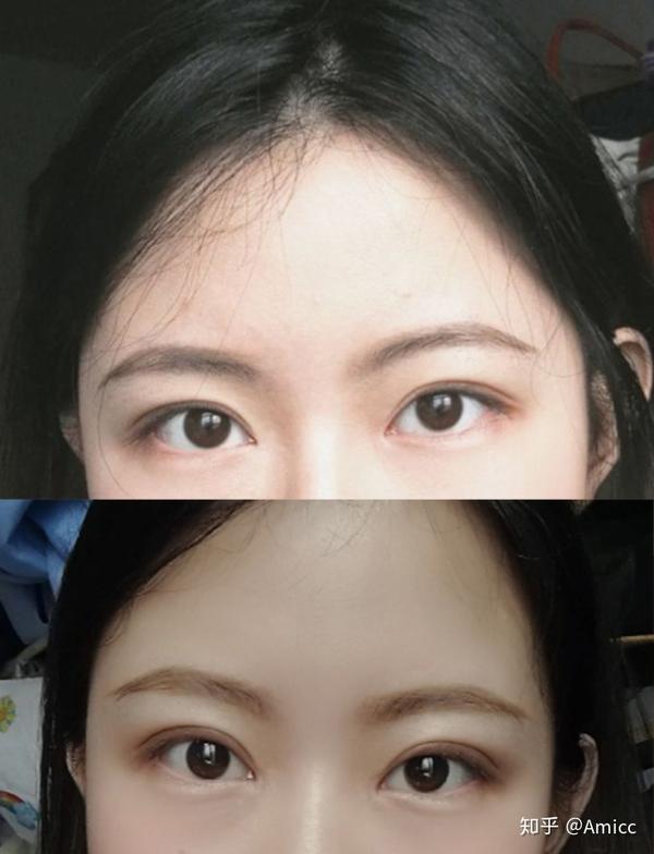 广州双眼皮花了11800,做成这样值吗?
