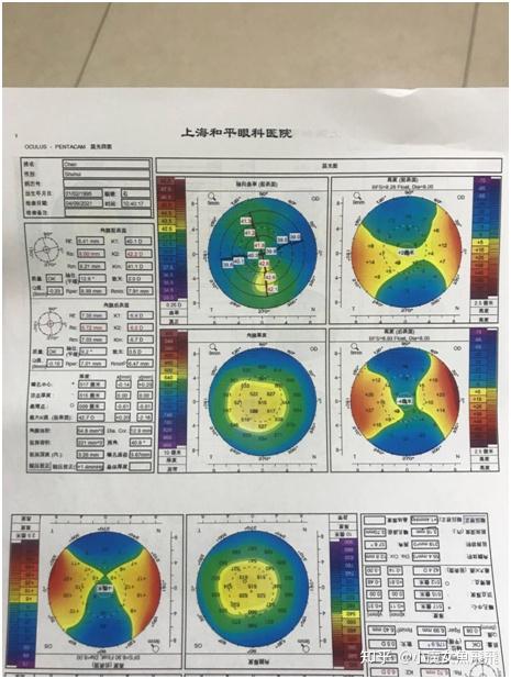 一部分检查报告,这是角膜地形图的