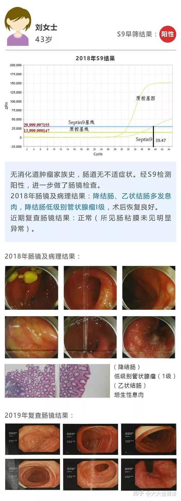 s9早筛阳性结果通过肠镜复诊后至少一半以上为息肉或癌症