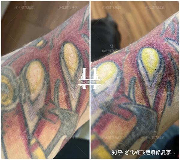 洗纹身增生疤痕,玩个游戏找不同吧