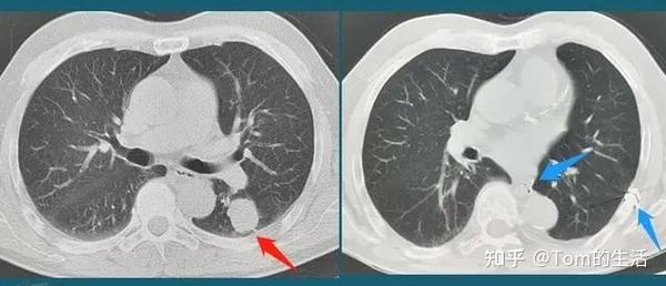 这2种肺结节,极易发展成肺癌!