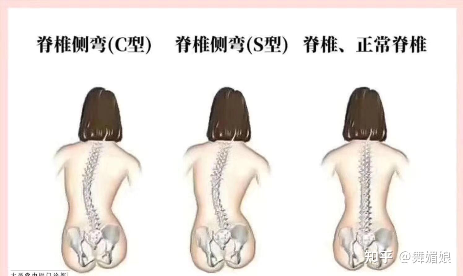 如何测评是否有脊柱侧弯的体型体态舞蹈生学习必备