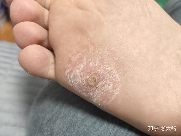 刀片割掉老肉,有点疼,看到里面的黑点,也不知道这突然冒黑点是什么