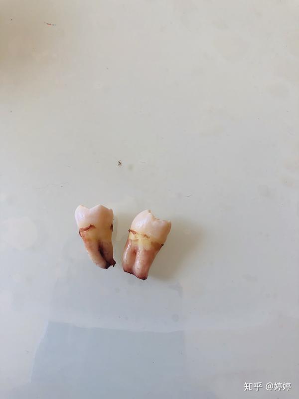 拔智齿有多难受?