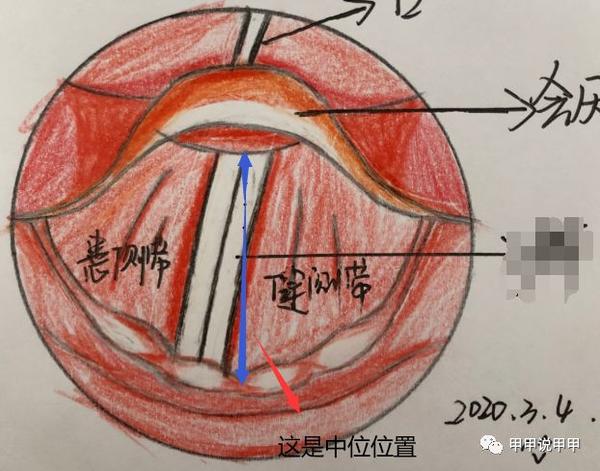 声带麻痹治疗之声带注射填充术医学动画讲解你肯定能看懂嗓音不好的看