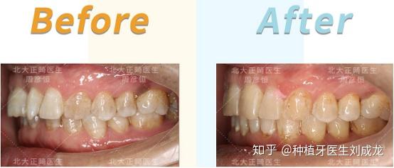 郑州隐适美矫正:59岁 深覆合 牙齿不齐 有假牙的男性隐形矫正患者案例