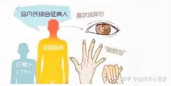 蜘蛛指 (趾)-马凡综合征为何如此凶险?