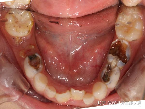 7岁男童满嘴烂牙,替牙期新长的牙还不是正常的牙,我该