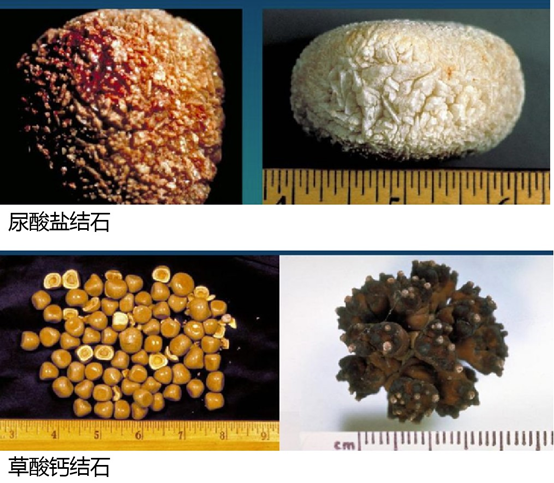 痛风/高尿酸血症患者出现泌尿系结石,未必就是尿酸盐结石