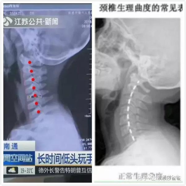 9岁男孩长期低头玩手机致颈椎严重畸形千万别再放纵孩子了