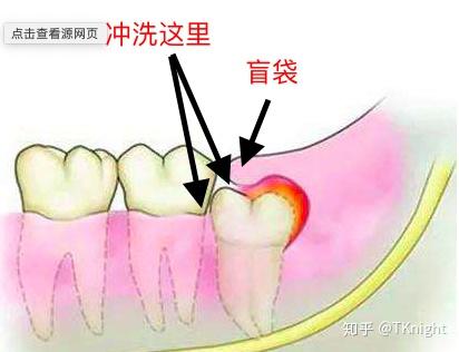 在美国得了智齿冠周炎怎么办?