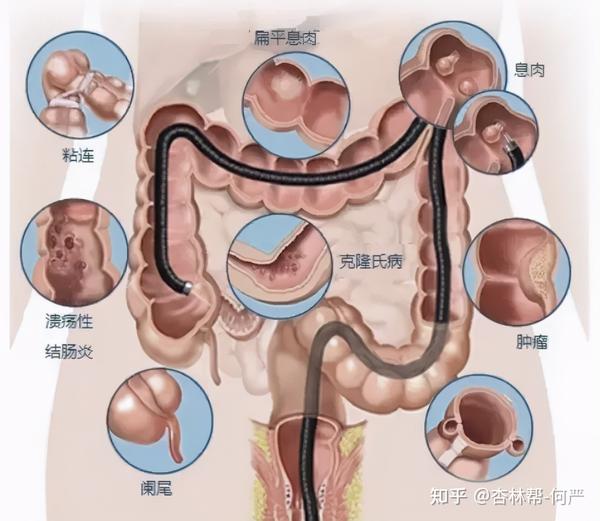 你想知道的肠镜检查常见问题都在这里了