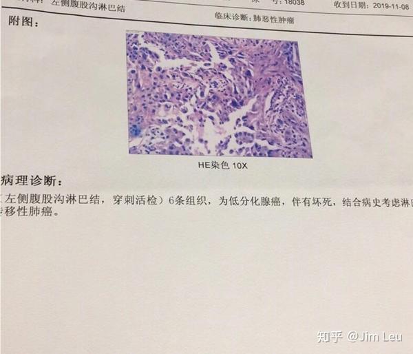 肺癌基因检测案例分析