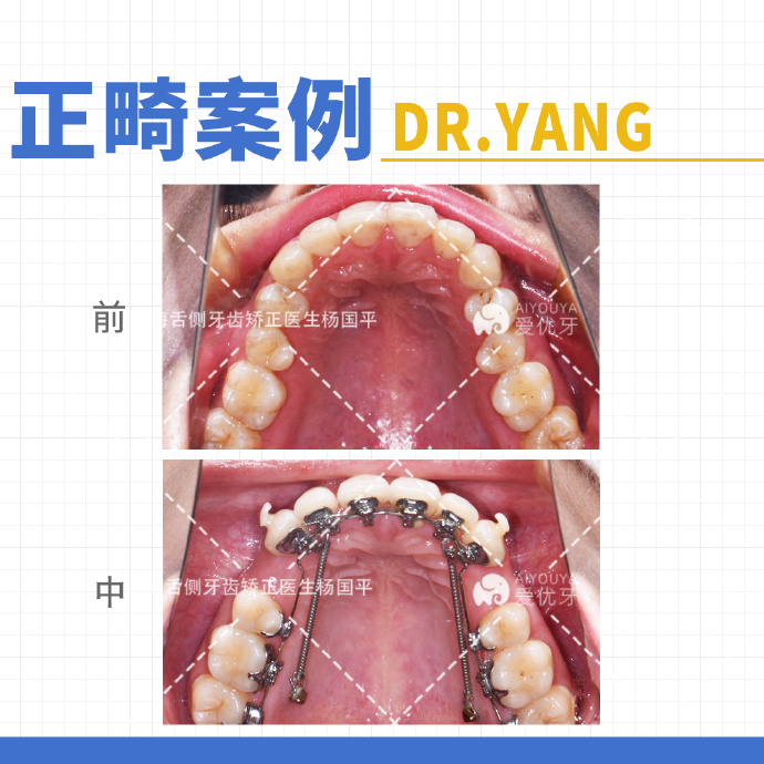 上海牙齿矫正深覆合覆盖下巴后缩舌侧更快速打开咬合