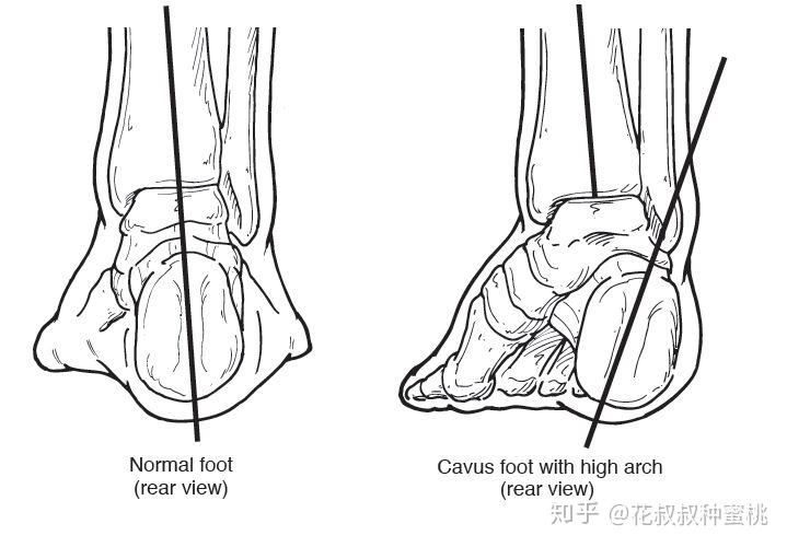 足弓与体态103关于高弓足