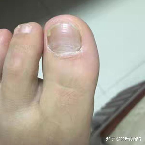 分享我治疗灰指甲的经历,希望能让病友们少走弯路
