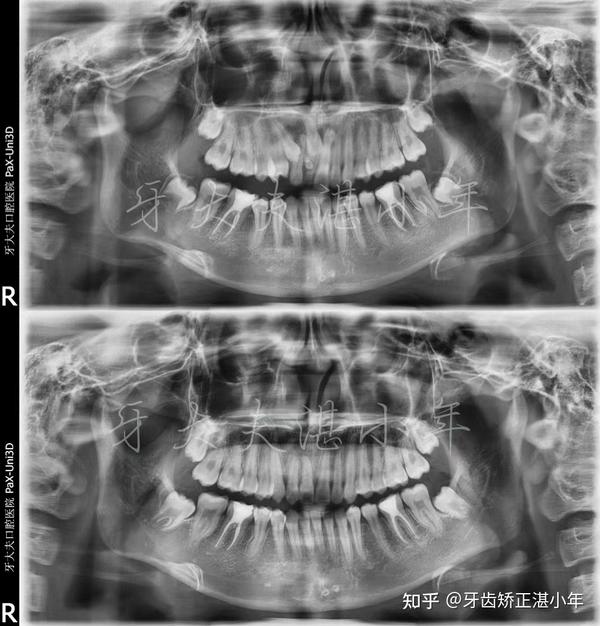说一下这个患者的牙齿情况:通过x光片可以看到患者乳牙滞留,右侧的