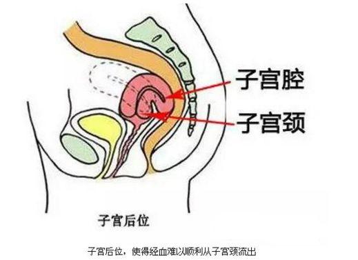 子宫后位想怀孕只能靠倒立大写的厉害