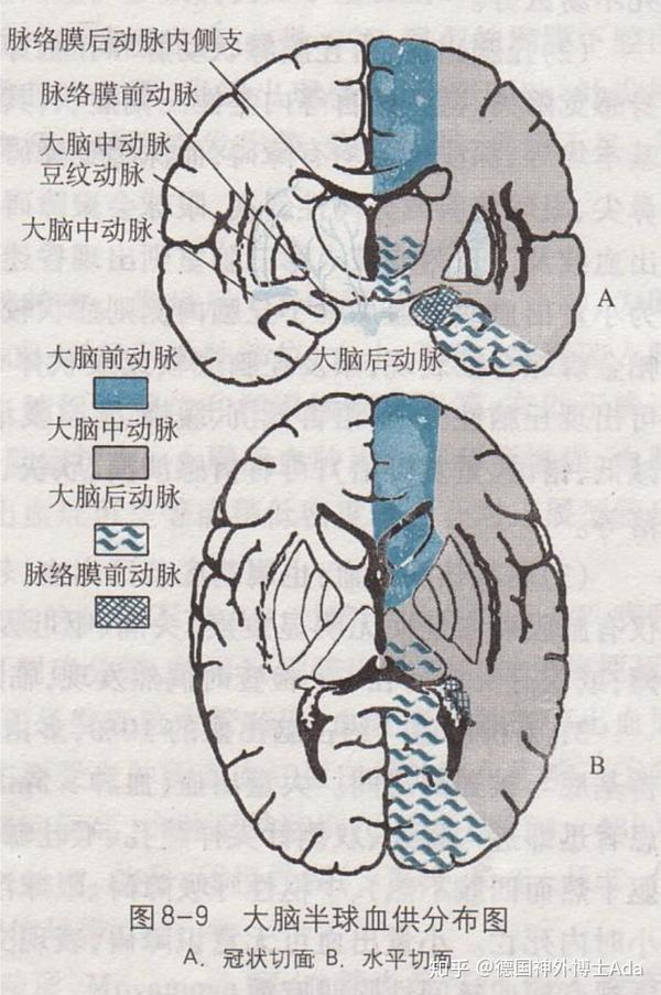 脑室出血→脉络丛血管破裂 绝大多数高血压性ich在基底节的壳核和内囊