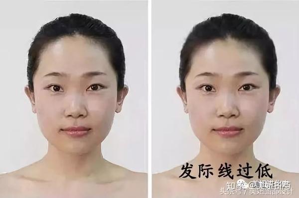 你的发际线影响到颜值了吗——50%的脸型是发际线问题
