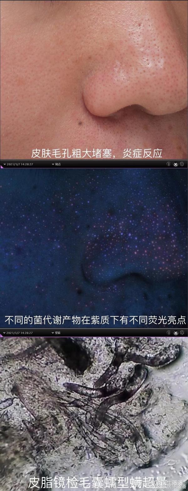 我的脸上竟然有虫子在蠕动!